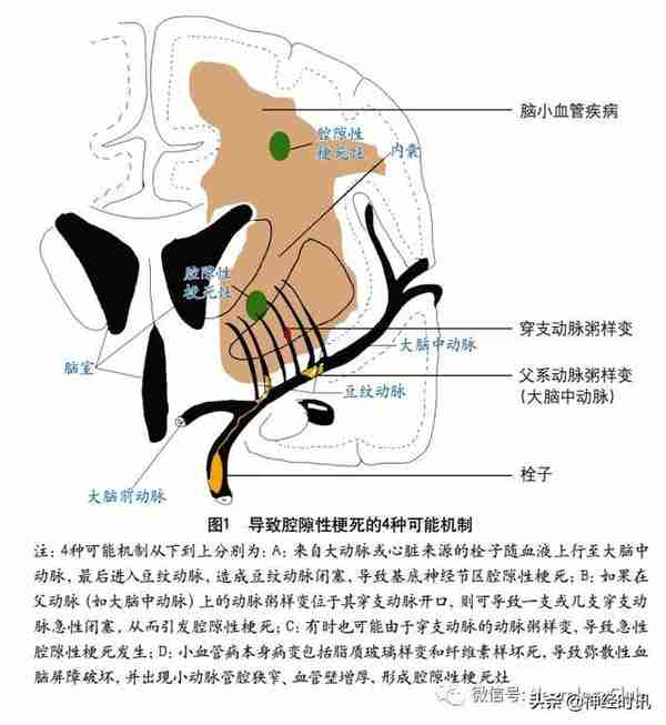 脑小血管病：犹如“风暴”过后的全脑灾难