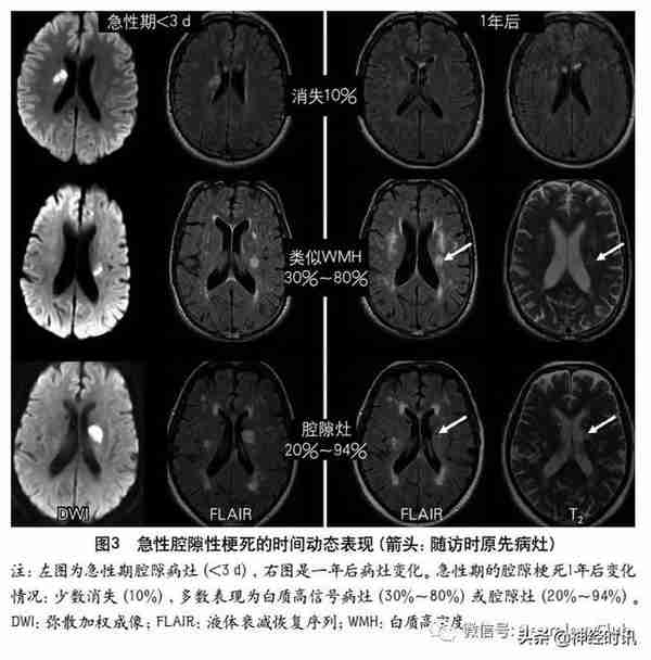 脑小血管病：犹如“风暴”过后的全脑灾难