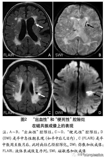 脑小血管病：犹如“风暴”过后的全脑灾难